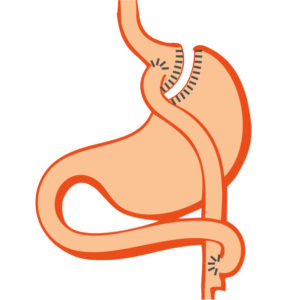 bypass-gastrique-obesite