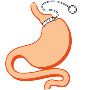 gastroplastie-obesite