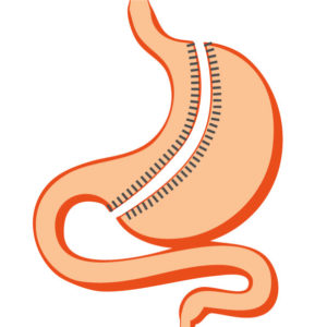sleeve-gastrectomie-obesite