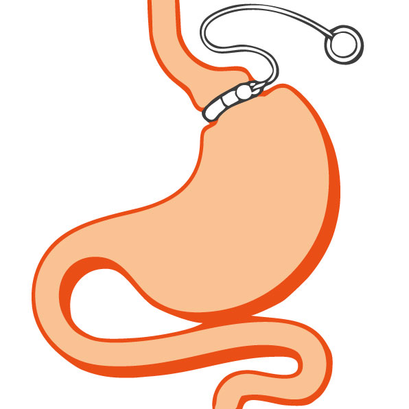 Anneau gastrique - Gastroplastie