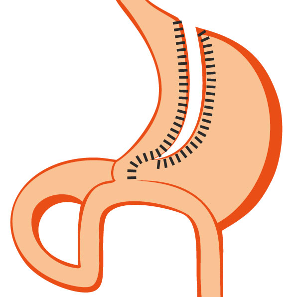 Bypass Gastrique Omega - Mini Bypass